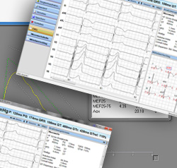 EKG